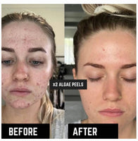 Algae peel for acne