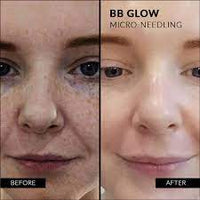 BB Glow Starter Kit (KFDA Approved) - BB Glow Treatments